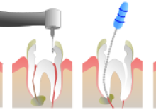 Baton Rouge Dentistry - Root Canal - Kramer Irby, DDS (by Jeremy Kemp)